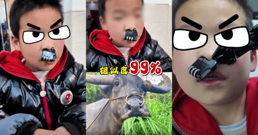 Mischievous Chinese Child Gets Combination Padlock Stuck in His Nose